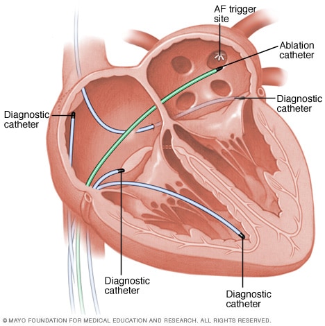 What is your life expectancy after being diagnosed with atrial fibrillation?