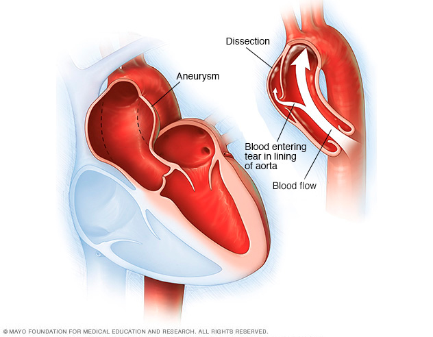 Aortic Dissection Symptoms And Causes Mayo Clinic