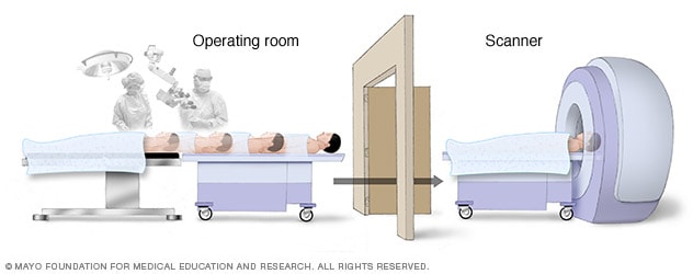 Illustration of intraoperative MRI