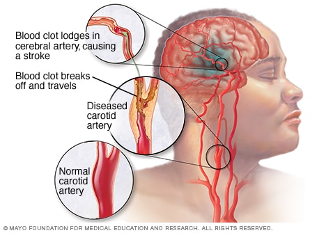 What causes strokes in the brain?