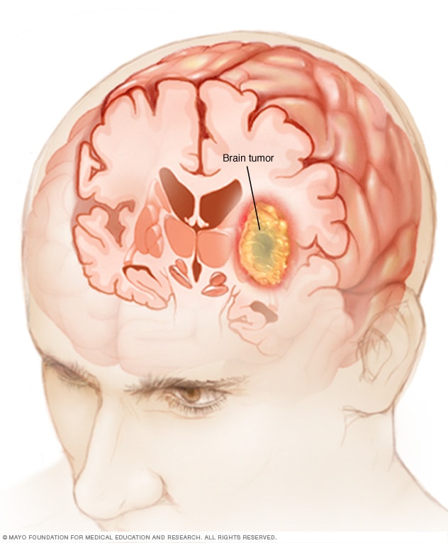 Image result for image of brain tumor