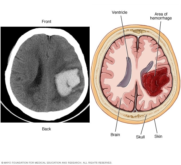 Hemorragia intracerebral