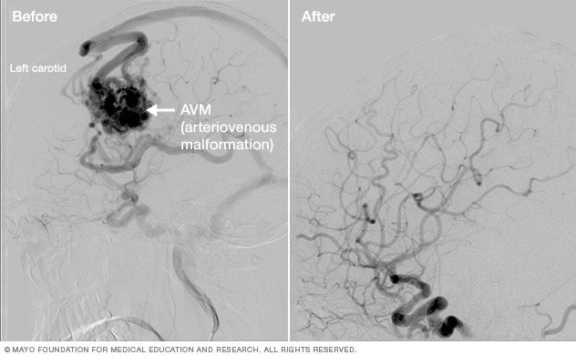 Brain arteriovenous malformation before and after Gamma Knife treatment