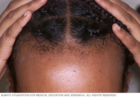 Repeated stress on the hair can cause a type of hair loss called traction alopecia.