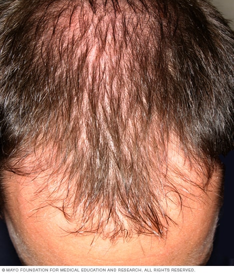 En hombres, el cabello generalmente comienza a caerse desde la frente.