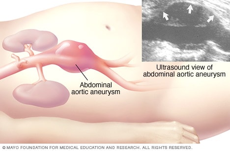 Ilustración de una ecografía abdominal de un aneurisma aórtico abdominal