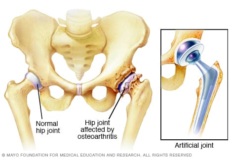 Arthritis damage and hip prosthesis
