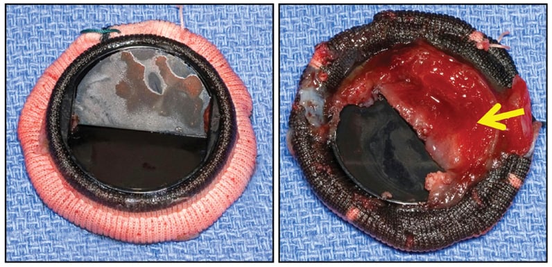 CarboMedics (29 mm) mitral valve prosthesis