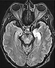 MRI showing abnormalities in temporal lobe and basal ganglia