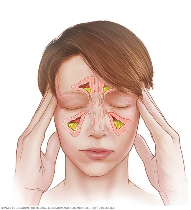 Acute sinusitis