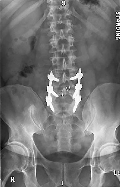 important notes to take during posterior lumbar fusion surgery Spinal fusion surgery is commonly performed in patients who require decompression for nerve root pain and whose symptoms are largely diskogenic implanted during . important notes to take during posterior lumbar fusion surgery Spinal fusion surgery is commonly performed in patients who require decompression for nerve root pain and whose symptoms are largely diskogenic implanted during .