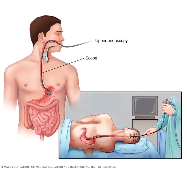 Illustration showing endoscopy