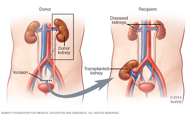 Nefrectomía laparoscópica de donante vivo de riñón