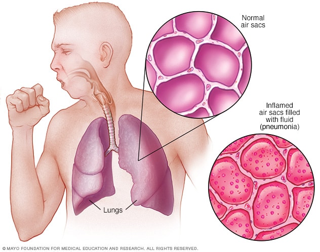 Pulmones con neumonía