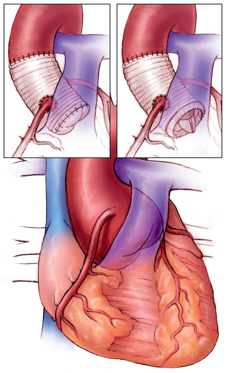 Operative repair of the aortic root