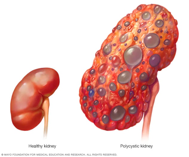 Polycystic kidney compared with normal kidney