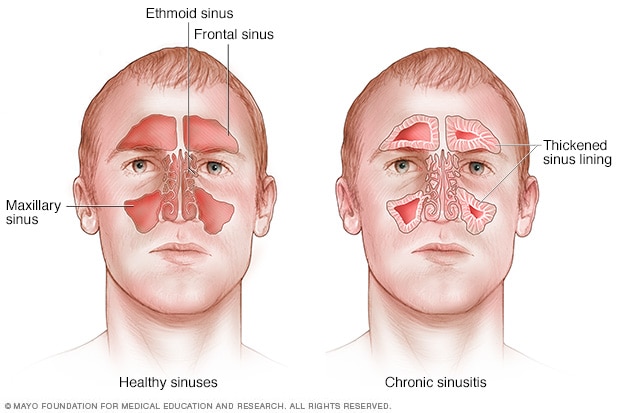 infected sinuses and sore throat