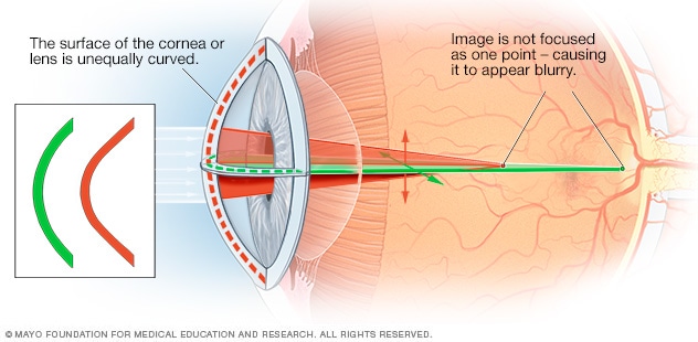 What is astigmatism?