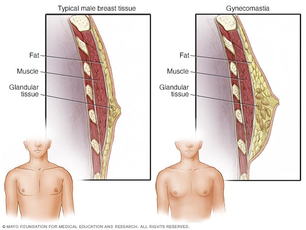 mcdc7_gynecomastia-8col.jpg