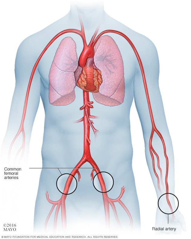 心脏导管插入术中的导管入路