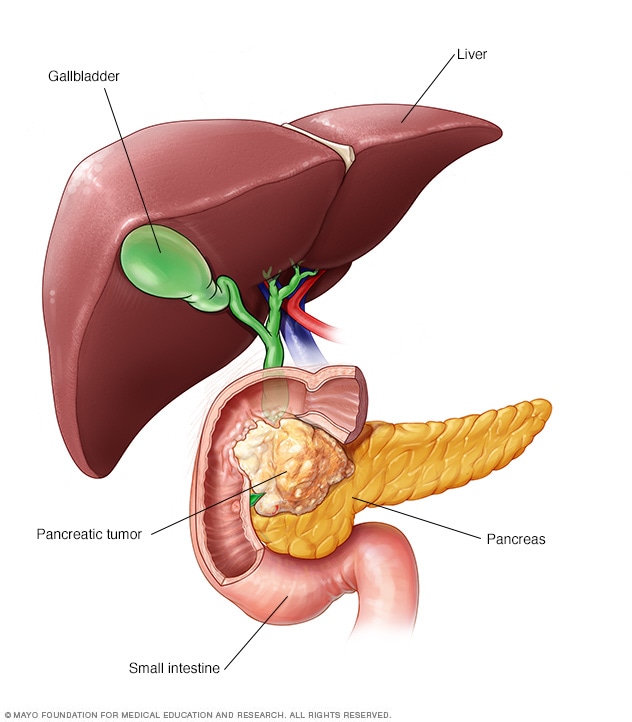 Image result for photo of pancreatic cancer