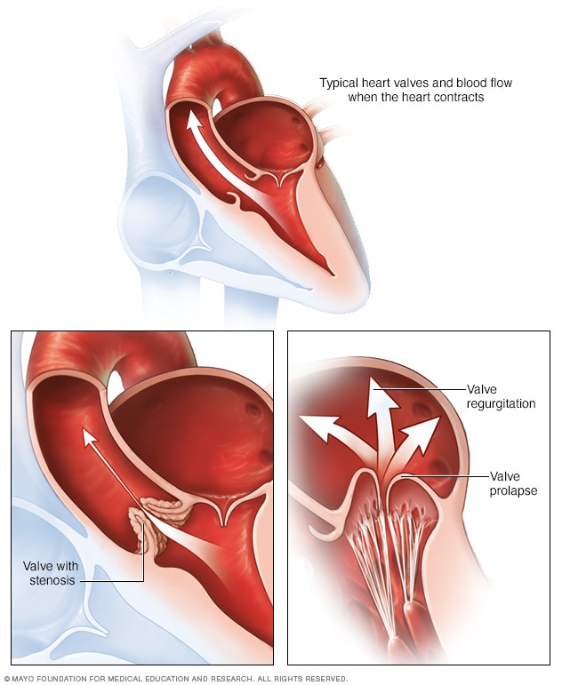 Corazón normal y problemas de válvulas cardíacas