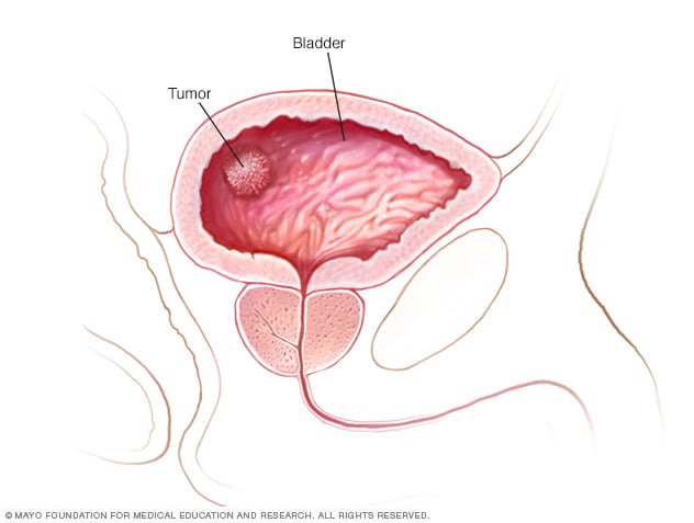 Tumor on the bladder wall