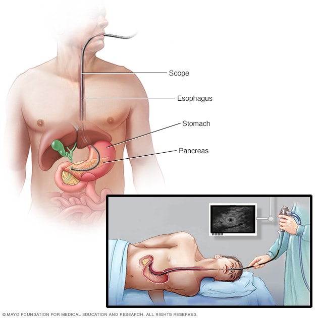 Dispositivo ecográfico que se pasa a través de un endoscopio hacia el abdomen