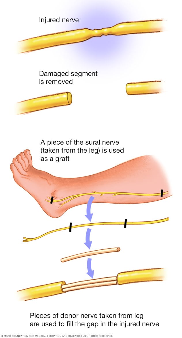 Un injerto de nervio de la parte inferior de la pierna