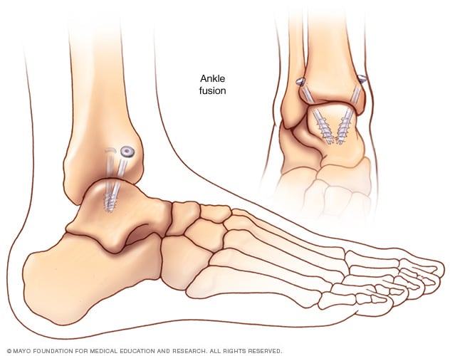An ankle fusion