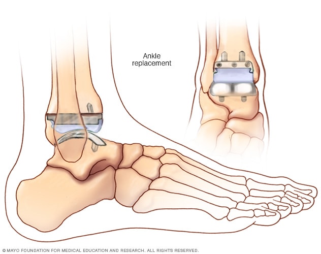 An ankle replacement