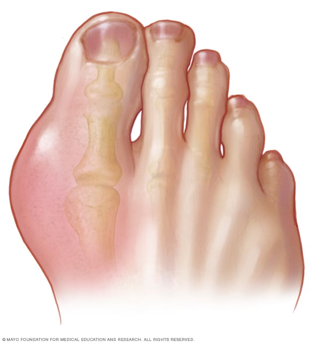 Pictures Of Gout 41