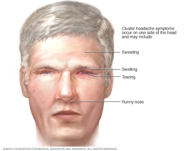 Síntomas de cefalea en racimos que afectan la cara.