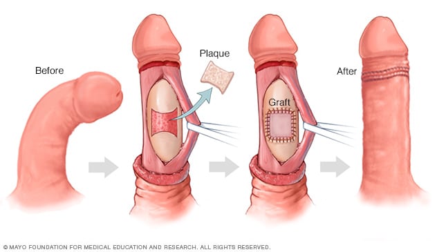 Graft repair of the penis to correct curvature or other deformity