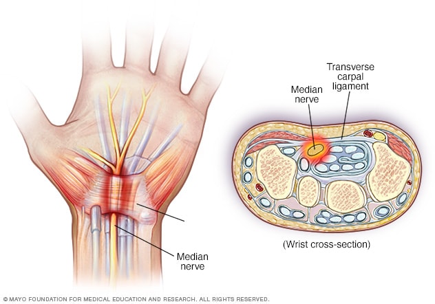 Image showing pinched nerve in wrist