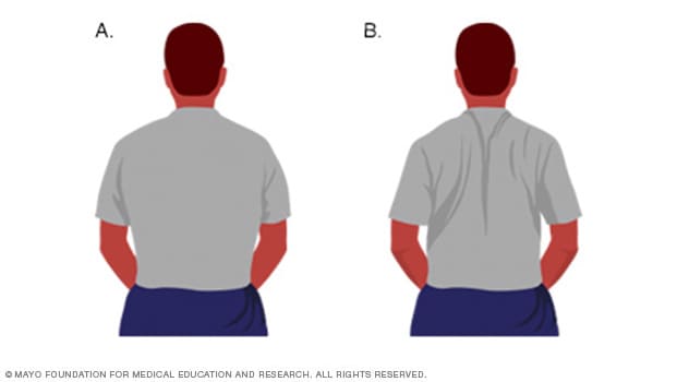 Illustrations of a person doing shoulder blade squeeze