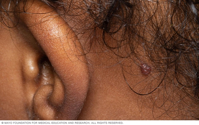 Imagen de una marca de nacimiento de tipo hemangioma detrás de una oreja