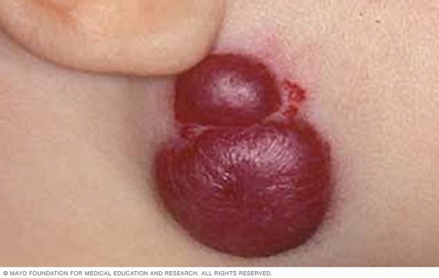 Imagen de una marca de nacimiento de tipo hemangioma debajo de una oreja