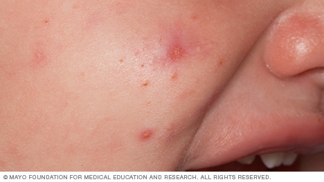 Photo of baby acne