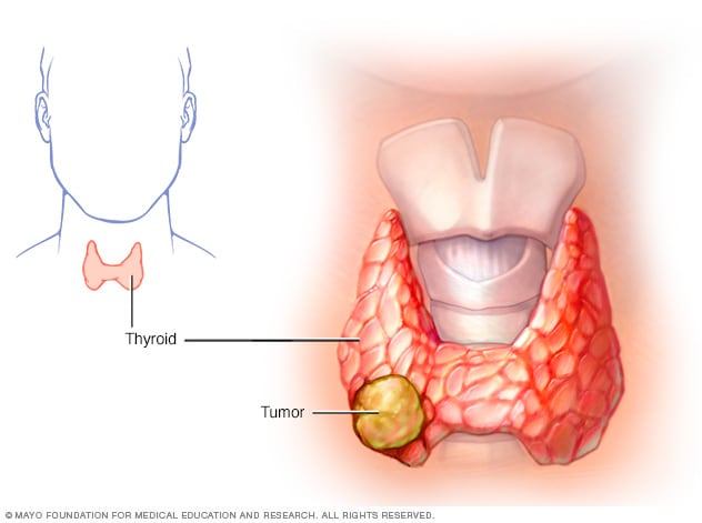 Illustration of thyroid cancer 
