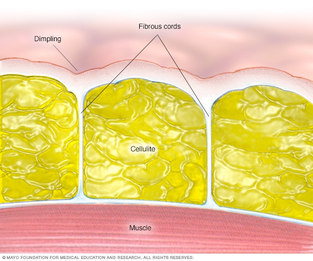 What Causes Cellulite On Legs Butt Certain Body Parts
