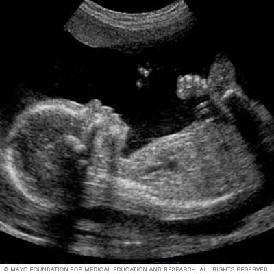 Image of a fetal ultrasound slide showing baby's profile 
