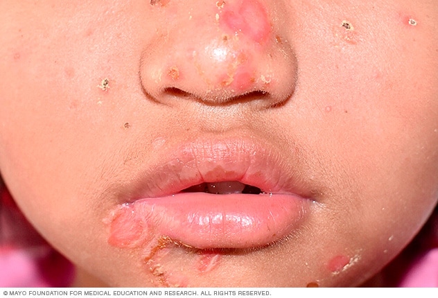 Impetigo or school sores in young children | Raising ...