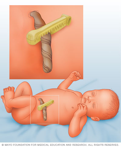 Image of umbilical cord at birth 
