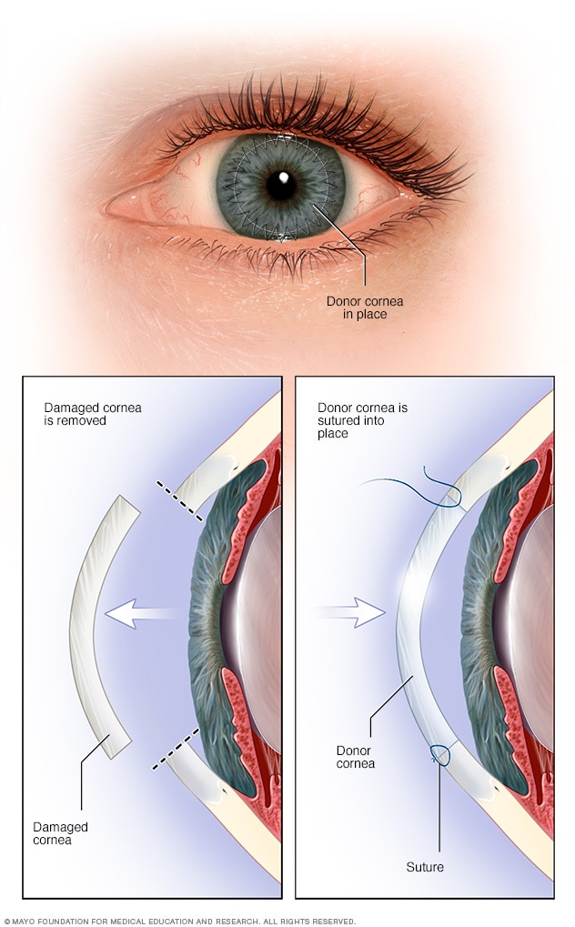 Illustration showing cornea transplant 