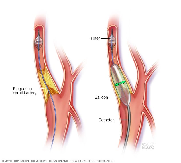 Image showing carotid angioplasty