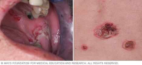 type of skin diseases