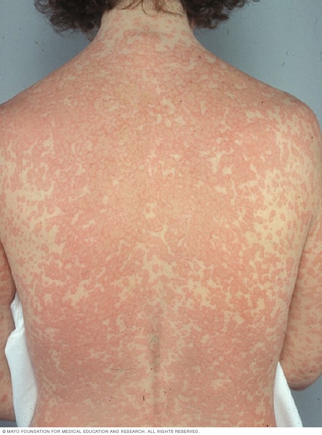 gabapentin rash description