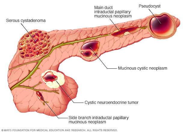 Illustration showing types of pancreatic cysts 

