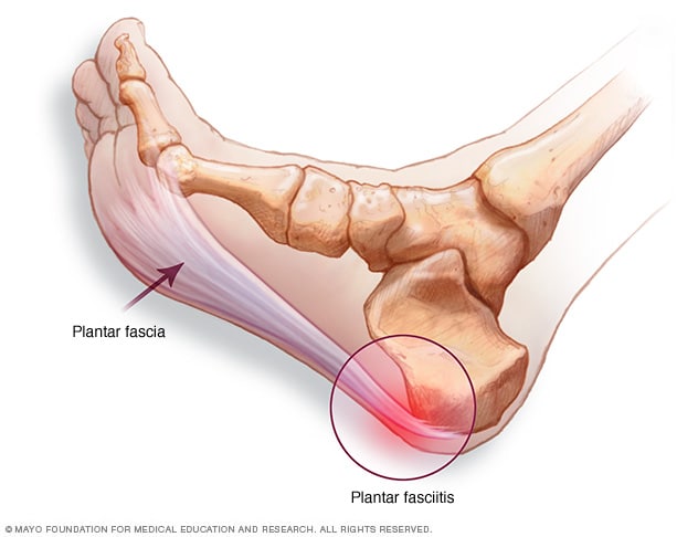 Illustration showing plantar fascia and location of heel pain 